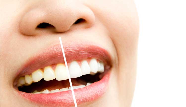 Diş Taşı Oluşumunun Nedenleri