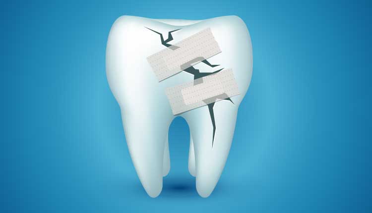 Ön Diş Çürüğü Nasıl Tedavi Edilir?